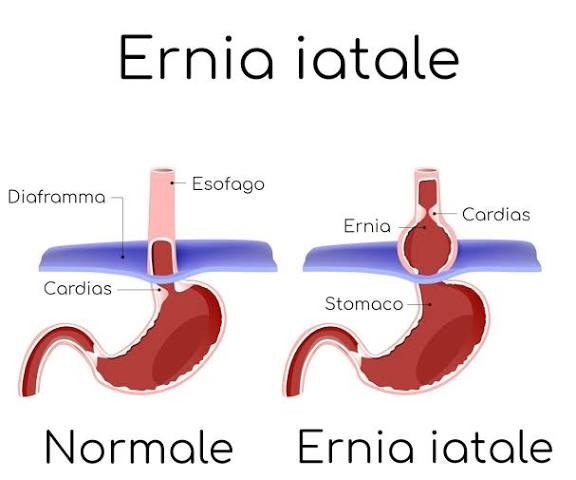 Schema dell’ernia iatale e del reflusso gastroesofageo