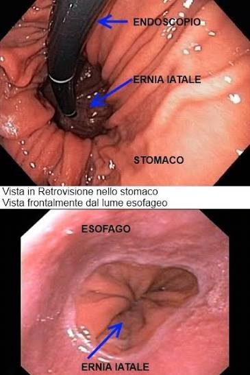 Immagini endoscopiche del reflusso gastroesofageo