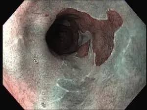 Immagine endoscopica dell’esofago di Barrett