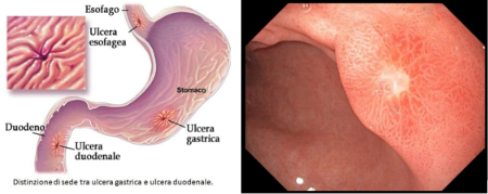 Ulcera gastrica in immagine endoscopica