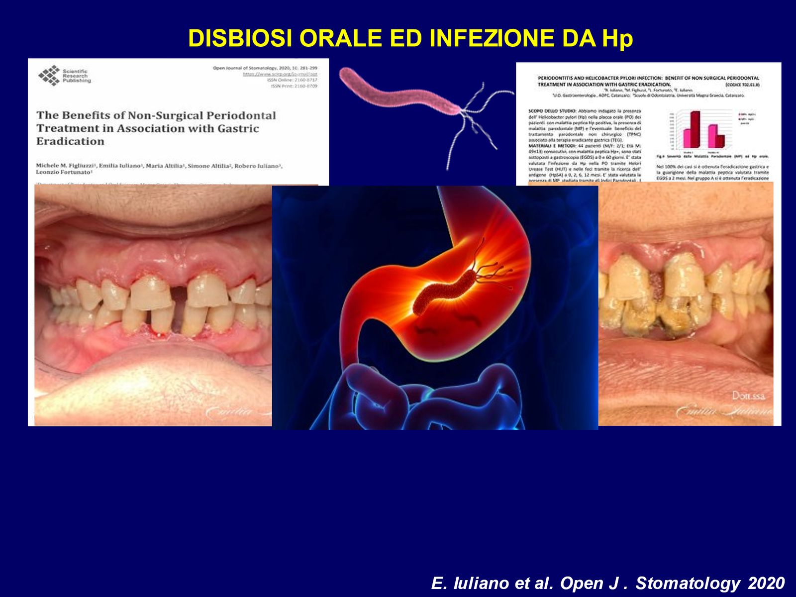 Disbiosi orale e infezione da Helicobacter pylori