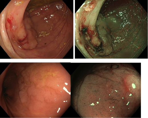 Polipi del colon osservati in endoscopia