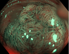 Lesione del colon osservata con NBI