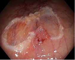 Lesione precancerosa del colon
