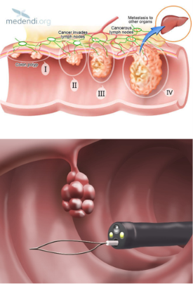 Schema di una procedura di polipectomia