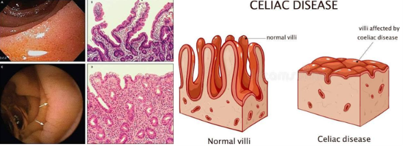 Alterazioni della mucosa nella malattia celiaca
