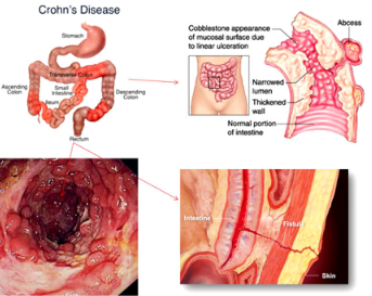 Morbo di Crohn