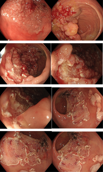 Lateral spreading tumor granular mixed di grandi dimensioni
