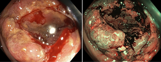 Tumore del colon, adenocarcinoma
