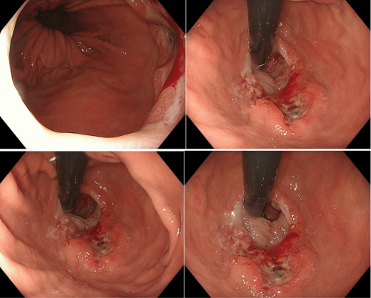Tumore gastrico sottocardiale, Helicobacter pylori positivo